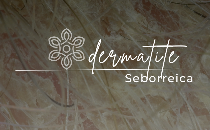 Coceira e descamação no couro cabeludo? Pode ser dermatite seborreica.